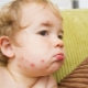 Prevention of chickenpox