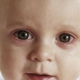 Conjuntivitis en niños.