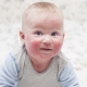 Atopic dermatitis in children