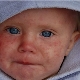 What does measles look like in children: initial symptoms