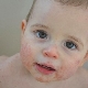 Unguento per bambini con dermatite atopica