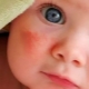 ¿Cómo es la dermatitis en los niños?