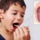 Symptoms, treatment and prevention of diphtheria in children