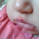 Herpes on the baby’s lip