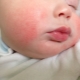 What does a baby’s skin allergy look like?