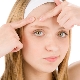 Treatment of teenage acne in girls