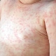 Rash on baby’s belly