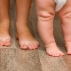 Valgus deformity in children