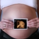 3D ultrasound during pregnancy