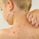 What to do if a child has a rash on a background of high fever?