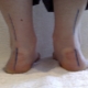 Treatment for flat-valgus foot in a child