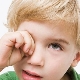 Blepharitis in children