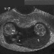 ¿Qué es la CTP fetal y cómo debería ser normal durante el embarazo?