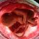 Wat betekent placenta verkalking en in welke vormen is het?