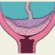 What does complete placenta previa mean and how is it dangerous during pregnancy?