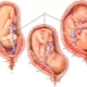 Wat is de presentatie van de foetus en wat is het effect?