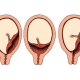 ¿Qué es la placenta previa y cómo afecta el embarazo y el parto?