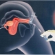 What is intrauterine insemination and how is the procedure performed?