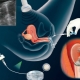 Embryo implantation sa IVF.Paano upang madagdagan ang mga pagkakataon ng tagumpay?