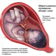 Is het gevaarlijk om de navelstreng rond de nek van de foetus te verstrengelen en welke invloed heeft dit op de bevalling?