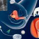 Bakit hindi palaging ang implantasyon ng embryo pagkatapos ng IVF? Mga sanhi at sintomas