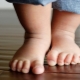 Esercizi per deformità del piede valgo nei bambini