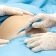 How many times can a cesarean section be done?