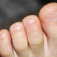 What to do if a child's toenails break or break?