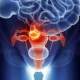 Diseases of the uterus in terms of psychosomatics