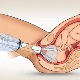 Applicazione del vuoto durante il parto