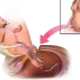 All about cesarean section