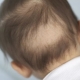 Hair falls out in infants: the causes and their elimination