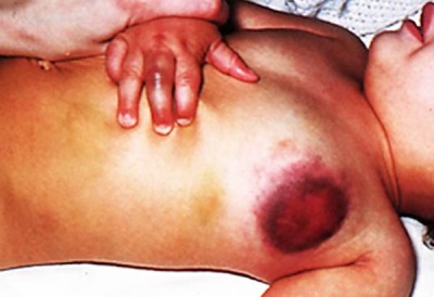 Hematomas in hemophilia in a child