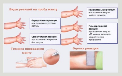 Evaluación de la reacción de Mantoux.