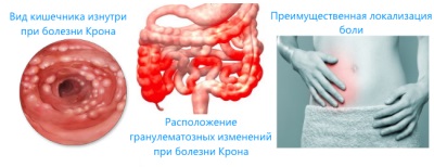 Enfermedad de Crohn