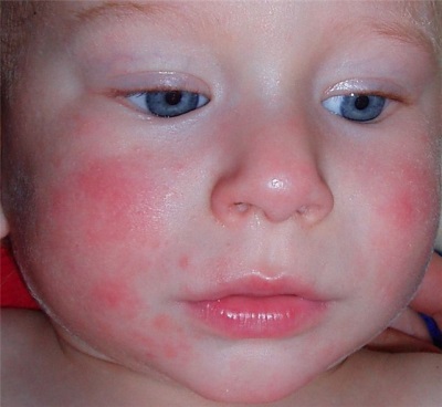 Allergic dermatitis in a child