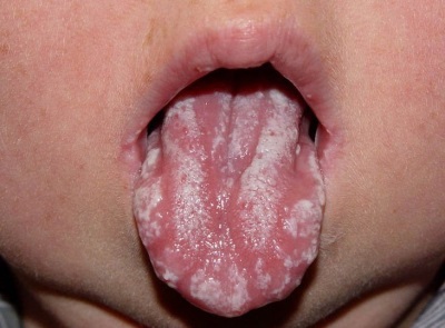 Stomatitis in infants