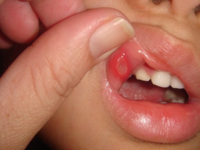 Aphthous stomatitis in a child