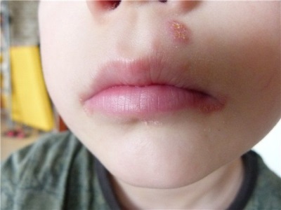 herpes en un niño