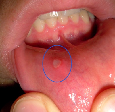 Stomatitis in a child