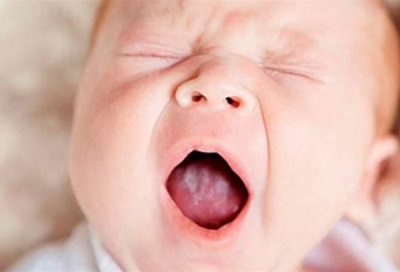 Stomatitis in infants