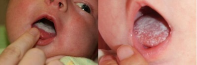 Stomatitis in infants