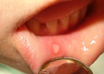 Aphthous stomatitis in a child