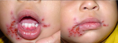 Herpes Stomatitis