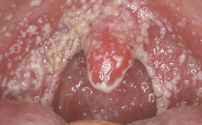 Candida stomatitis