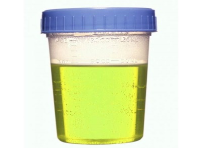 Green urine in a child