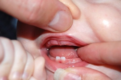 baby's teeth are climbing