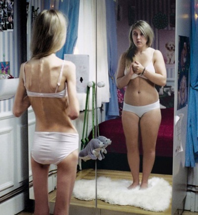 Anorexia en una adolescente