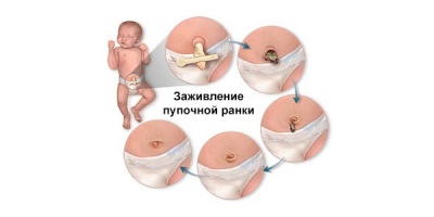 Healing navel of newborn