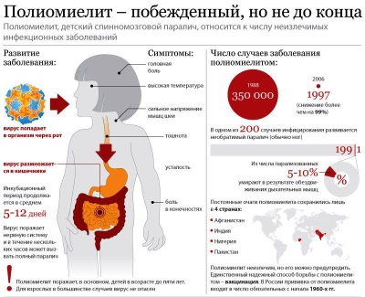 Poliomyelitis